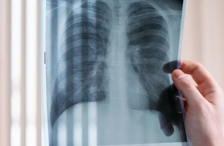 肺大泡的危害有哪些？